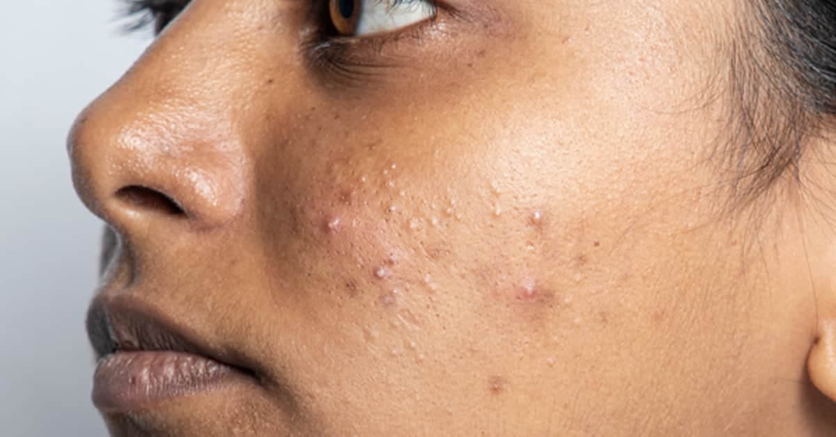 Effective Solutions for Acne-Prone Skin