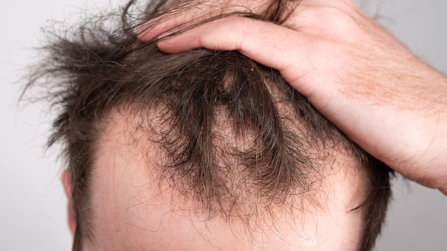 Effective Treatments for Hair Loss