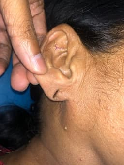 Before Ear Lobe Repair