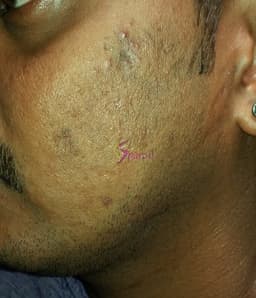 After FRF Skin Resurfacing