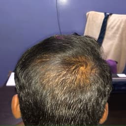 After Hair PRP Therapy