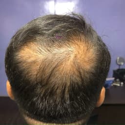 Before Hair PRP Therapy